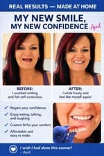DIY Full Denture Kit Make Your Own Teeth At Home Affordable Missing Tooth USA - image 3